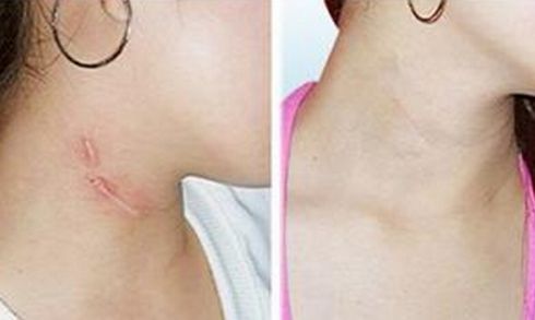 昆明近視手術醫(yī)院推薦及費用指南