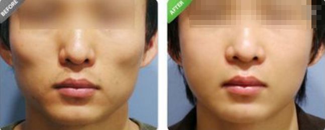 深圳哪家醫(yī)院的拉皮除皺效果最好？排名前幾位的醫(yī)院有哪些？