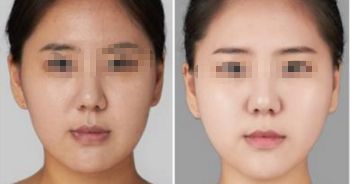 上海八院脂肪填充手術(shù)費(fèi)如何？專家拆解詳情及特色優(yōu)勢(shì)