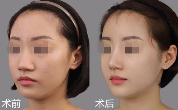 廣州拉皮哪家醫(yī)生技術比較好？TOP5名醫(yī)大揭秘