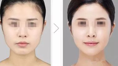 長(zhǎng)沙雙眼皮整形醫(yī)院推薦，哪家效果更好？