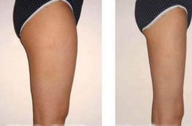 西京醫(yī)院手臂吸脂術(shù)費(fèi)用揭秘：知名醫(yī)生推薦及價(jià)格清單