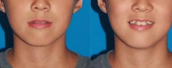 沈陽雙眼皮手術(shù)價(jià)格參考，名流、百嘉麗、杏林整形費(fèi)用更新【2024最新】