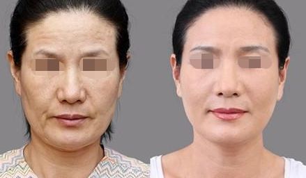 徐州哪家醫(yī)院割雙眼皮效果好？前四名醫(yī)院盤點