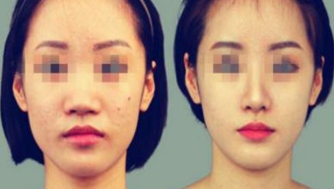 沈陽哪家醫(yī)院做面部大拉皮除皺效果好？排行榜前十推薦