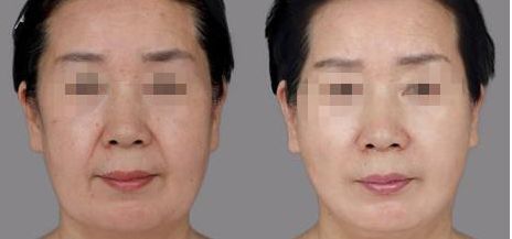 樂山哪家整形醫(yī)院雙眼皮比較好？匯總單六強(qiáng)預(yù)測