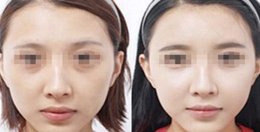 邯鄲哪家醫(yī)院做乳房整形效果好？