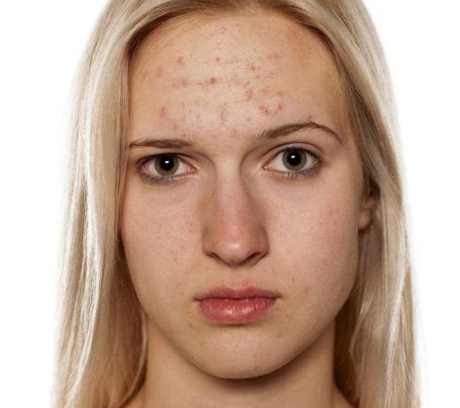 成都哪家醫(yī)院激光祛斑效果比較好？