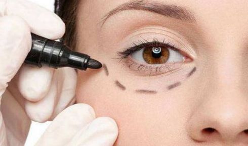 南京友誼醫(yī)院雙眼皮修復(fù)成功案例揭秘，資深大夫傾情詮釋