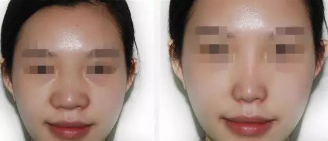 哈爾濱哪家醫(yī)院做隆鼻好？醫(yī)療技術(shù)排行幫你快速選擇