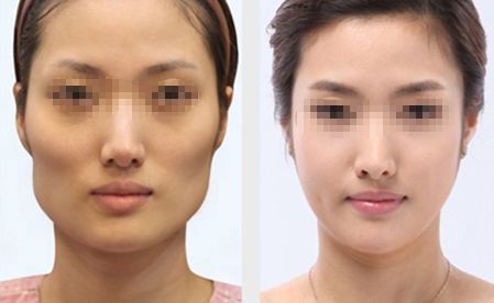 深圳隆胸醫(yī)院推薦：專業(yè)經(jīng)驗豐富、口碑好的醫(yī)院