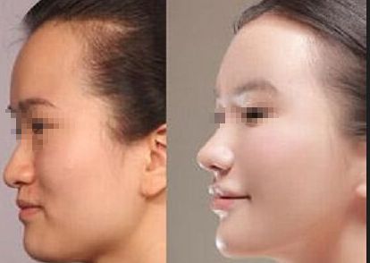 成都恒博植發(fā)效果如何？真實(shí)案例分享與價(jià)格分析