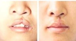 深圳雙眼皮醫(yī)院哪家專業(yè)醫(yī)師值得信賴？