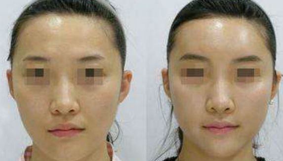 溫建民拇指外翻手術(shù)費(fèi)用實(shí)惠，術(shù)前術(shù)后效果一流