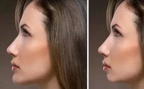 成都哪家醫(yī)院的肋骨鼻修復效果好？推薦幾位專業(yè)的鼻修復醫(yī)生