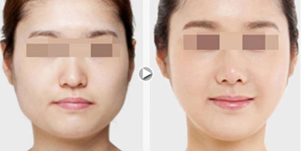 懷化哪家脂肪填充整形醫(yī)院口碑好？前八測評曝光！