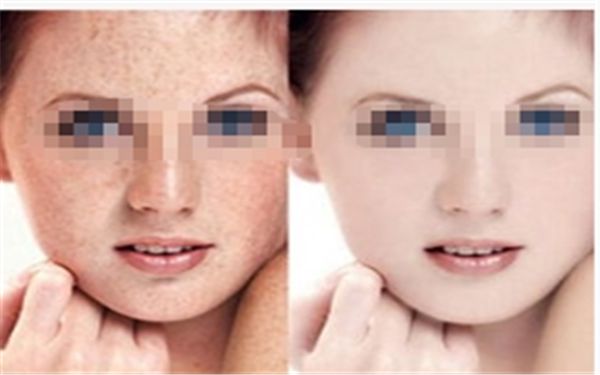 合肥哪家醫(yī)院近視激光手術(shù)靠譜？