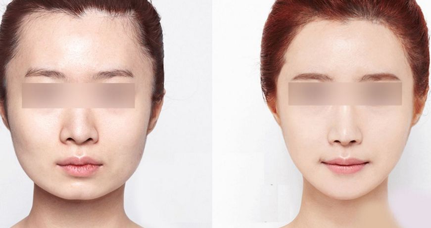 2024年南昌哪家醫(yī)院的唇部整形效果好呢？