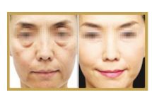 日照哪家醫(yī)院做雙眼皮手術(shù)技術(shù)高效？