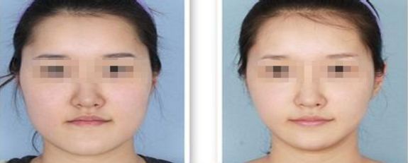 福州吸脂手術(shù)哪家醫(yī)院技術(shù)先進(jìn)受用戶好評(píng)