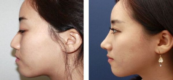 北京大腿抽脂專家推薦，哪個醫(yī)院技術(shù)好？