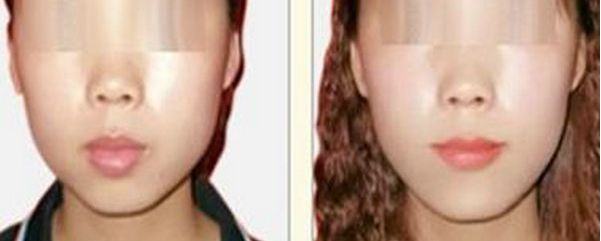 深圳哪家醫(yī)院祛斑效果較好？