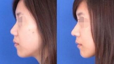 2024年長沙權(quán)威整形醫(yī)院指南：隆鼻選亞韓，隆胸選do胸