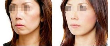 2024珠海雙眼皮手術(shù)醫(yī)院推薦，幫您預(yù)測(cè)前五家