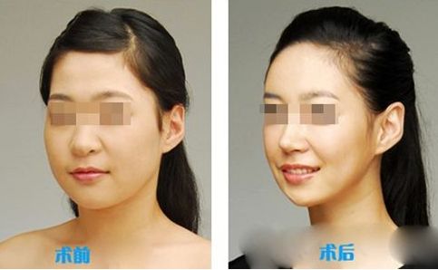 肌功能矯治，哪個(gè)階段適合兒童早期干預(yù)？哪些醫(yī)院堪稱專家？