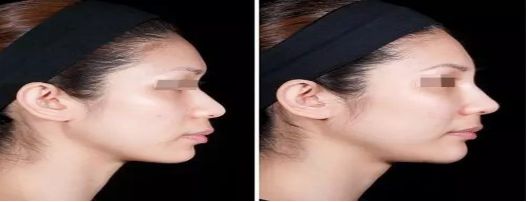 廣州哪家整形醫(yī)院祛痘效果比較好？去痘患者首選醫(yī)院排行榜