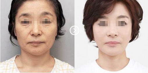 蘇州奧克拉醫(yī)院的整形效果及評價如何？