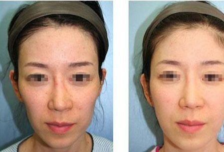 沈陽鼻整形醫(yī)院排名前5，專家推薦！