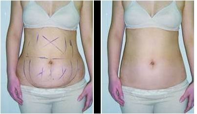 浙江哪家醫(yī)院做吸脂好？TOP10醫(yī)院推薦