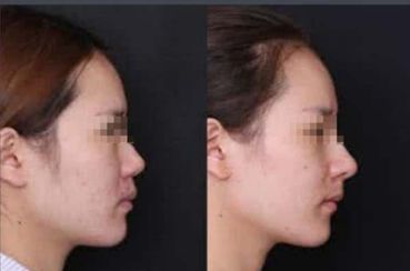 寧波哪家醫(yī)院做隆鼻手術(shù)效果好？