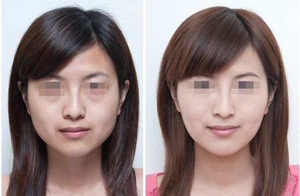 合肥哪家雙眼皮修復(fù)效果好？排名前十的整形醫(yī)院大揭秘