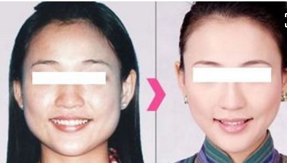 重慶華美分層抗衰超聲炮體驗：效果和醫(yī)生技術分析