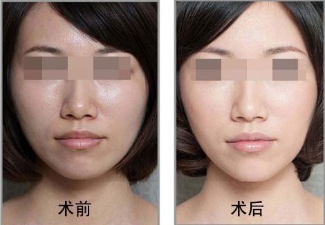 佛山哪家整形醫(yī)院是喬雅登個(gè)人推薦的Top7