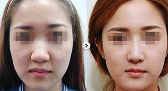 上海愛爾眼科醫(yī)院近視眼視力矯正方案解析：技術(shù)、價格、醫(yī)生介紹全攻略