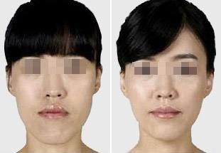 濟(jì)南最好的雙眼皮手術(shù)醫(yī)院推薦