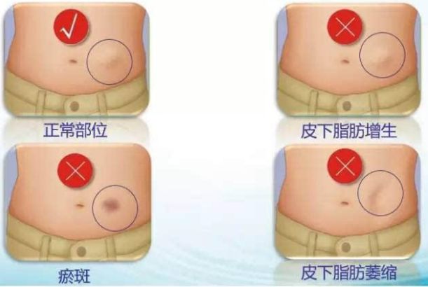 獲悉四川地區(qū)專業(yè)自體脂肪隆胸醫(yī)院，解決您的疑慮