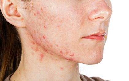 廣州常春藤眼科近視眼矯正：微創(chuàng)全飛秒，15800元起，快速恢復(fù)