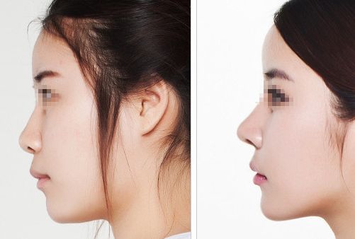 汕頭名流整形醫(yī)院：拉雙眼皮、吸脂價(jià)格一覽，專家解讀真實(shí)案例