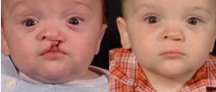 愛美人士必看！艾莉薇PK伊婉玻尿酸，功效、使用范圍、持久度對比