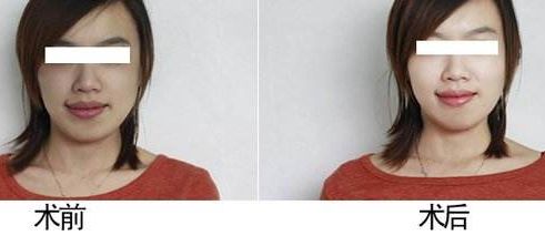 蘇州隆胸醫(yī)院哪家效果最好？排行榜公布