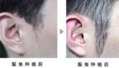 開眼角手術(shù)改善眼型，揭秘適合人群