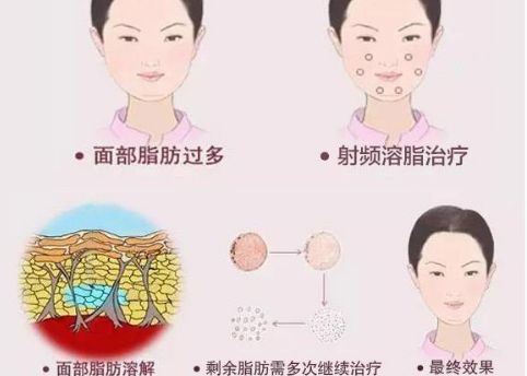 韓國整形醫(yī)院眼鼻綜合對(duì)比：普露菲耳 vs POP