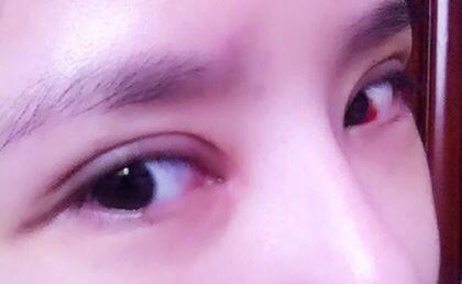 廈門光電治療打眼紋醫(yī)生