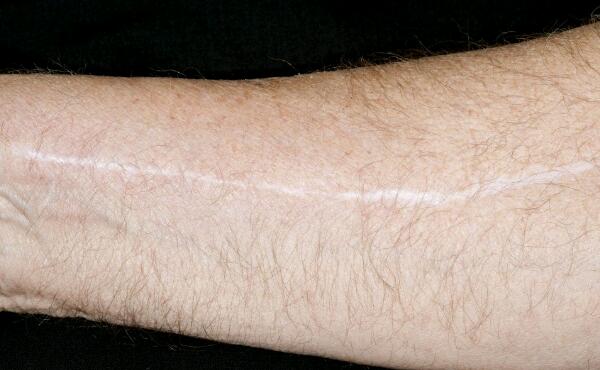 成都膠原蛋白去木偶紋醫(yī)生