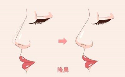 重慶膠原蛋白填充面部醫(yī)生