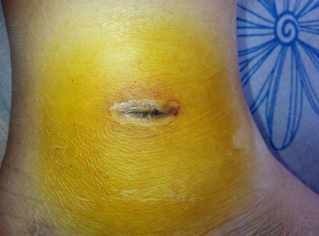 杭州激光去除青春痘醫(yī)生